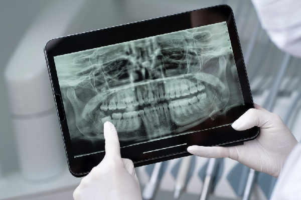 OPG Full mouth X ray